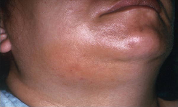 RĂNG KHÔN MỌC LỆCH  VÀ NHỮNG BIẾN CHỨNG KHÔNG NÊN CHỦ QUAN