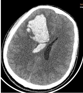 ĐỘT QUỴ NÃO Ở NGƯỜI TRẺ:  ĐỪNG CHỦ QUAN VỚI NHỮNG DẤU HIỆU BAN ĐẦU