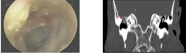 CHOLESTEATOMA TAI – TỔN THƯƠNG NGUY HIỂM KHÔNG NÊN CHỦ QUAN