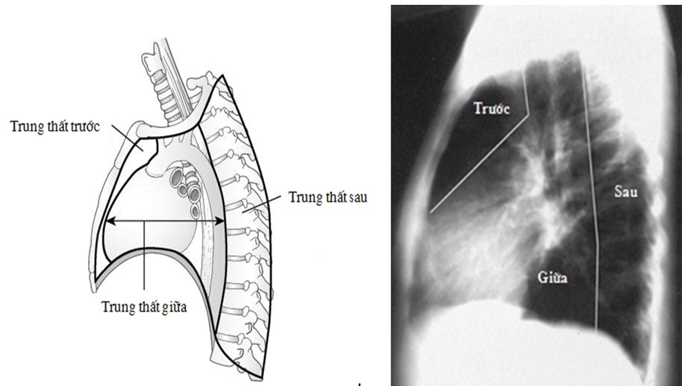   PHẪU THUẬT NỘI SOI ĐIỀU TRỊ U TRUNG THẤT TẠI BỆNH VIỆN ĐA KHOA TỈNH BẮC NINH