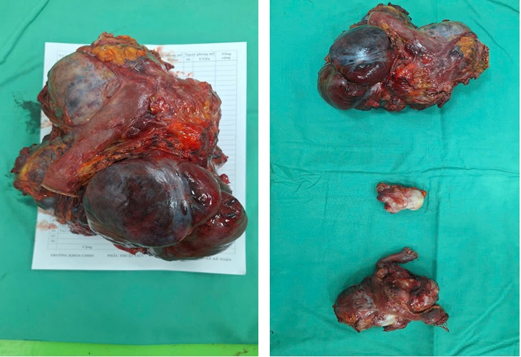 PHẪU THUẬT LOẠI BỎ BA KHỐI U Ổ BỤNG NGHI GIST TÁI PHÁT, KHỐI LỚN NHẤT NẶNG 2,7 KG