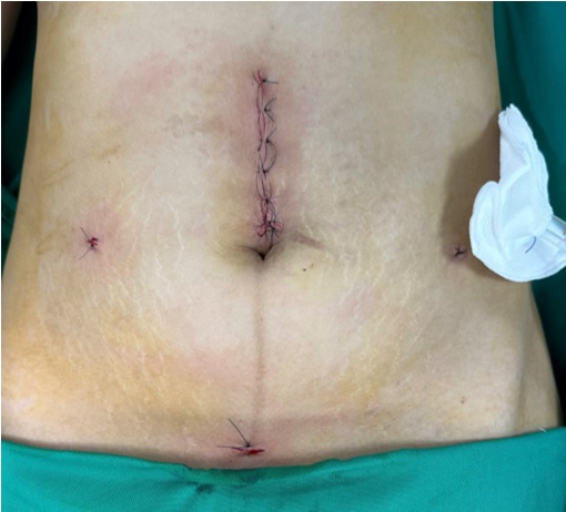 PHẪU THUẬT NỘI SOI THÀNH CÔNG KHỐI U ĐẠI TRÀNG KÍCH THƯỚC LỚN CHO BỆNH NHÂN 32 TUỔI