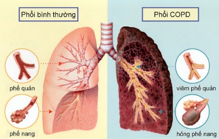 TÁC HẠI CỦA VIỆC HÚT THUỐC LÁ - Bệnh viện đa khoa tỉnh Bắc Ninh